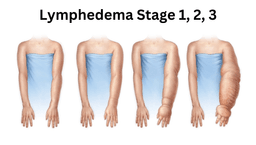 Image for Initial Lymphedema Assessment