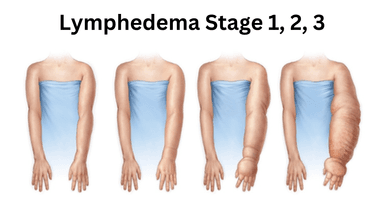 Image for Initial Lymphedema Assessment